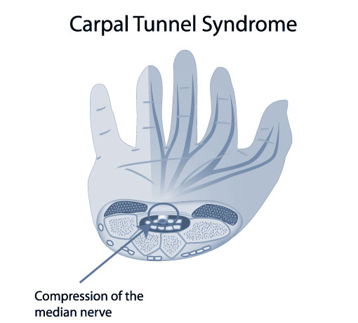 Carpal Tunnel Syndrome