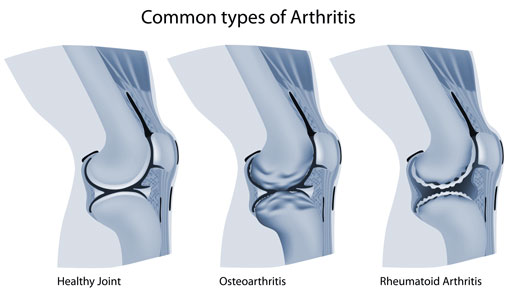 Knee Arthritis | Dunham Orthopaedics