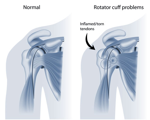 Shoulder Rotator Cuff