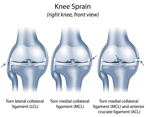 Torn MCL (Medial Collateral Ligament) Knee